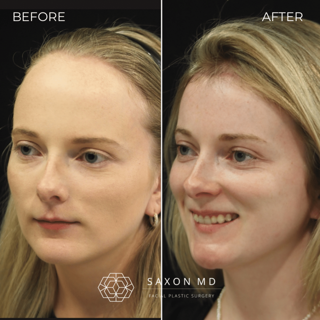 Forehead Reduction Surgery Before And After