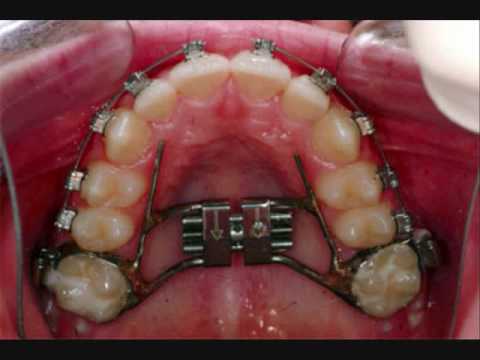 Image result for palate expanders