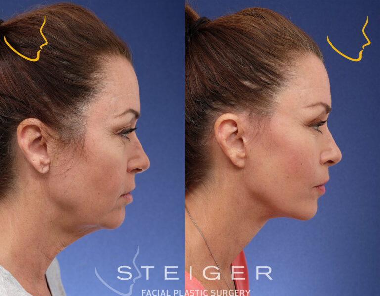 facelift-insta0oct-768x599.jpg