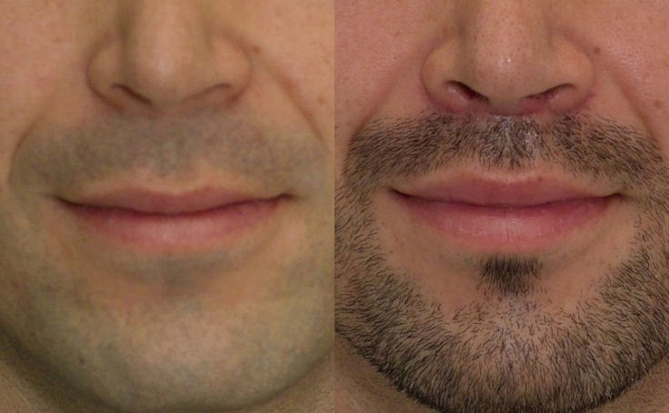 lip-lift-male-before-after-f-194.jpg
