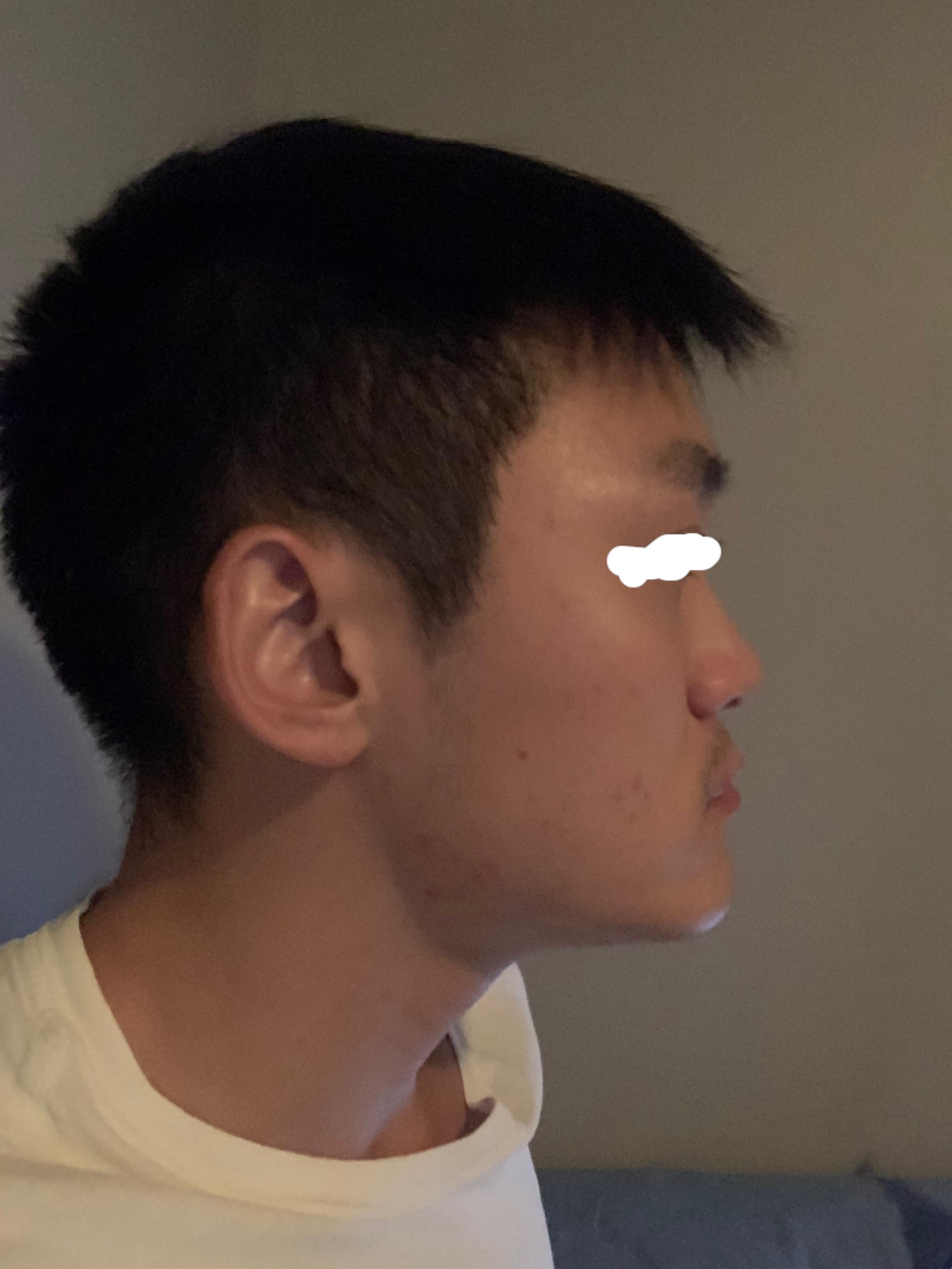 Is my maxilla recessed or below average? I think it's why my cheek bone fat  is noticeable from the side and top profile. : r/orthotropics
