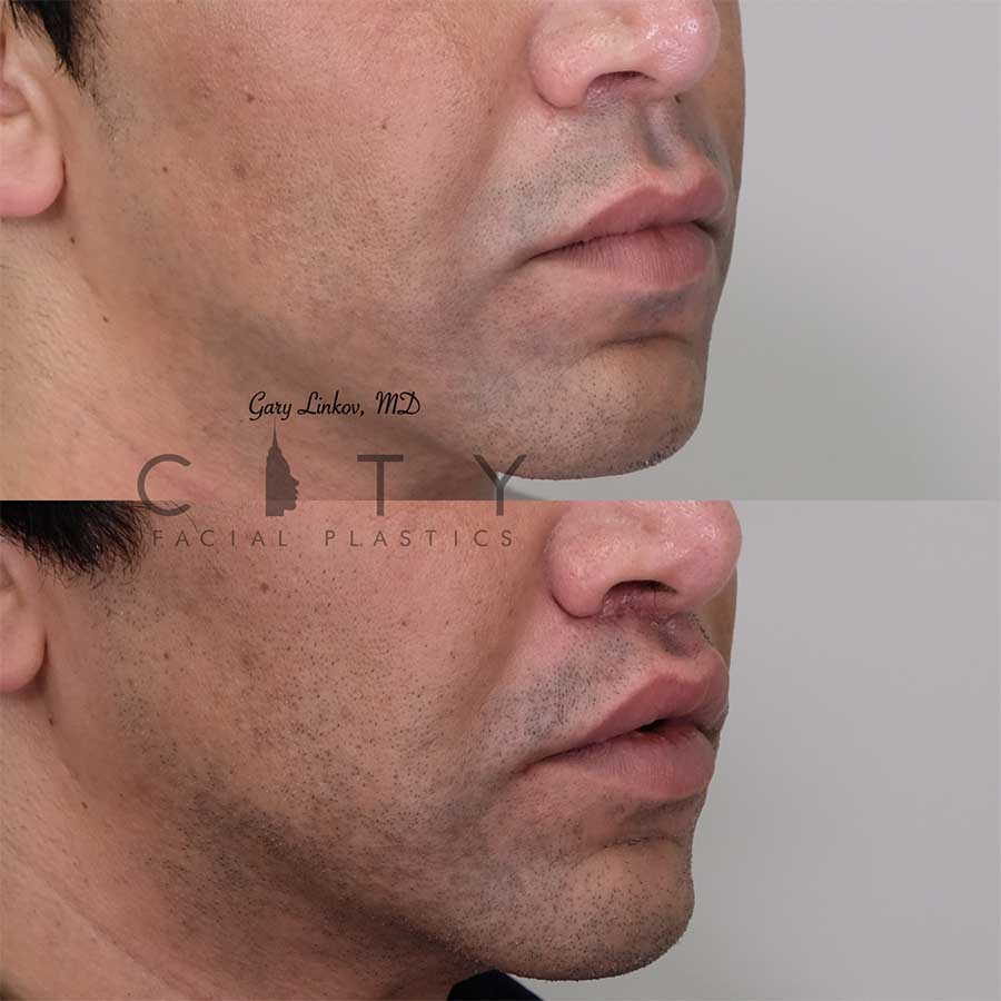 Lip-lift-17-R-three-quarter-case1.jpg