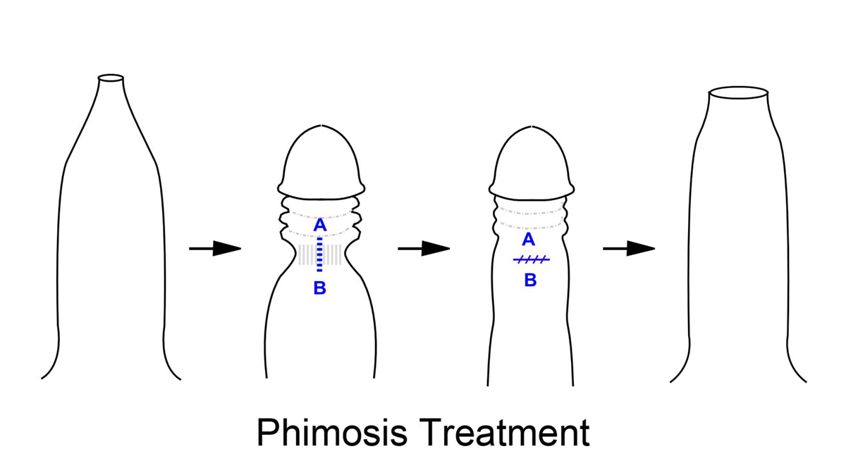 phimosis-treatment.jpg