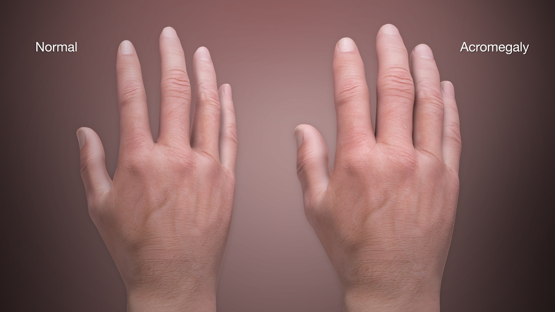 medical-animation-acromegaly.jpg