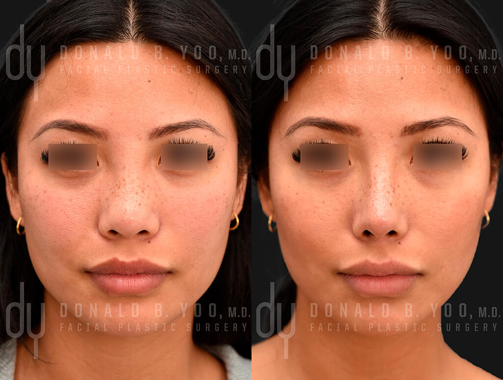 Asian-Rhinoplasty_Before-and-After.jpg