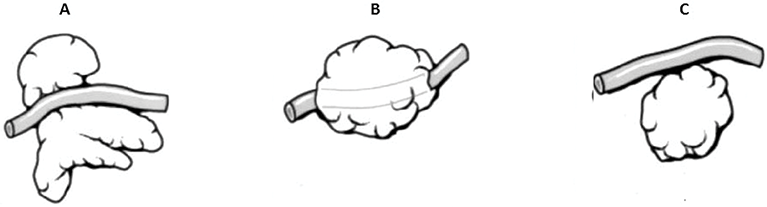 Figure 4.Relationship of the BFP with the parotid duct. (A) Type A: the parotid duct travels over the buccal extension. (B) Type B: the parotid duct travels through the buccal extension. (C) Type C: the parotid duct travels superior to the buccal extension of the BFP (Hwang et al. [18]).