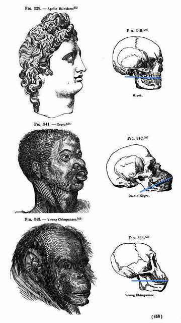 Prognathism.jpg