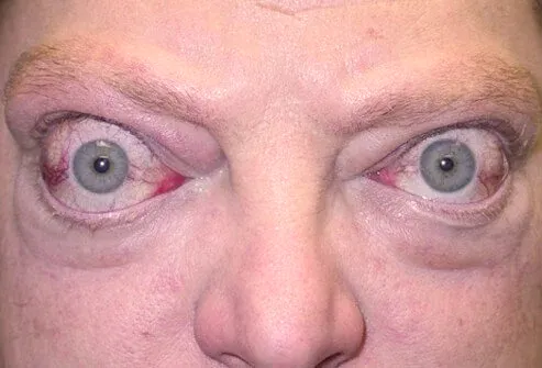 bulging-eyes.jpg