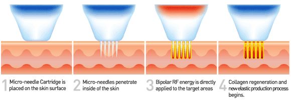RF-Microneedling.jpg
