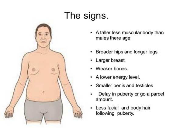 What does a person with Klinefelter syndrome look like? - Quora