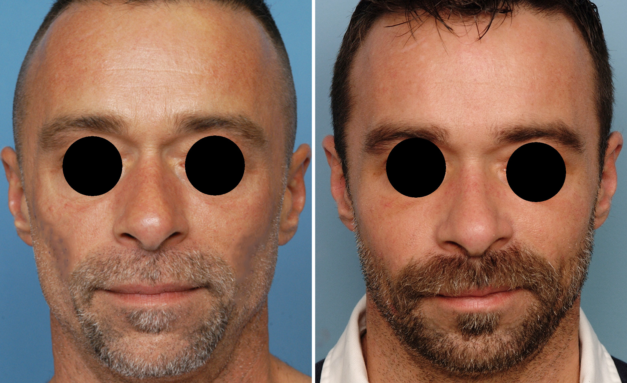 Submalar-Cheek-Implants-for-Facial-Lipoatrophy-Dr-Barry-Eppley-Indianapolis.jpg