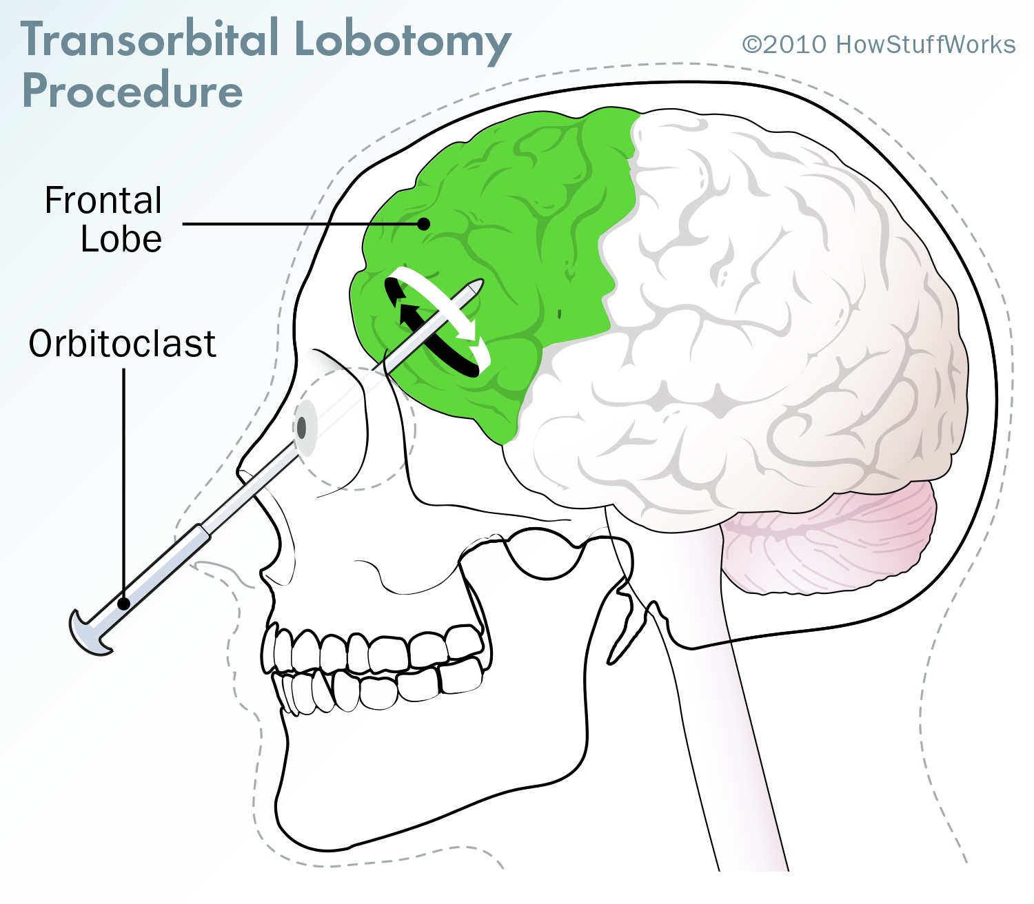 unethical-medicine-lobotomy-orig.jpg