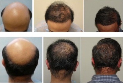 hair-restoration-0893.jpg