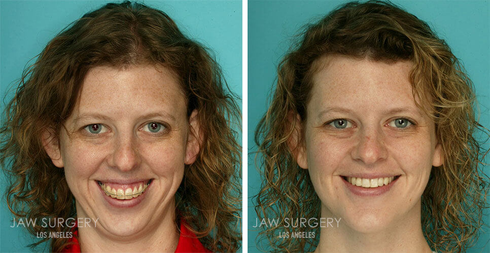 before-after-patient-03b.jpg