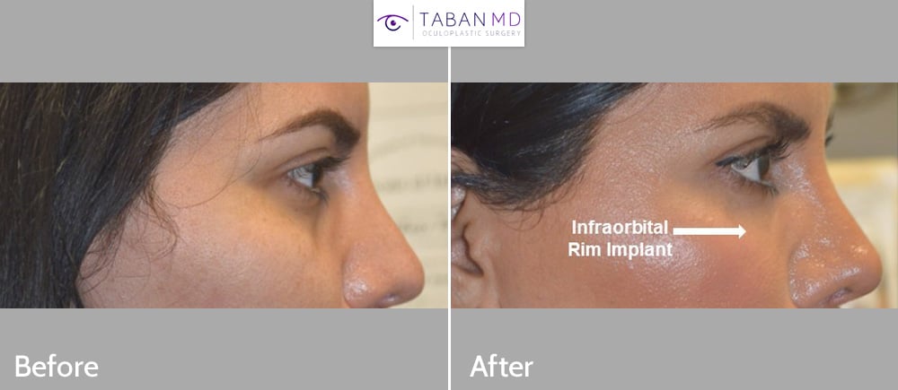 Transgender female underwent customized infraorbital rim implant surgery (including tear trough area).