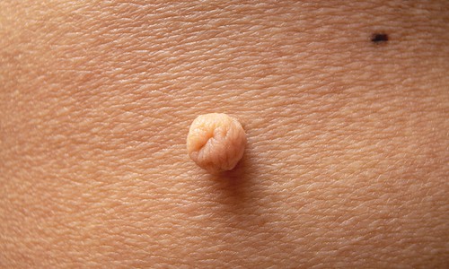 Skin Tags - Skin Surgery Clinic