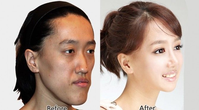 Here's 15 Of The Most Insane Before And After Korean Cosmetic ...