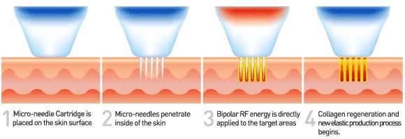 RF-Microneedling.jpg