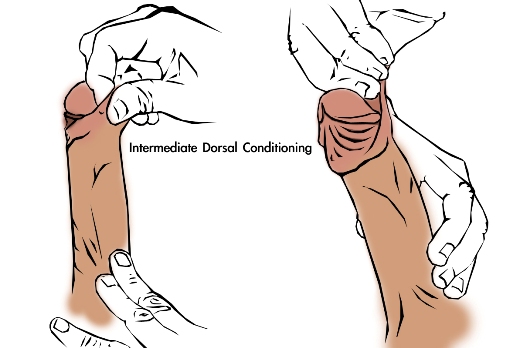 foreskin-restoration-manual-tugging-method-1-dorsal.jpg