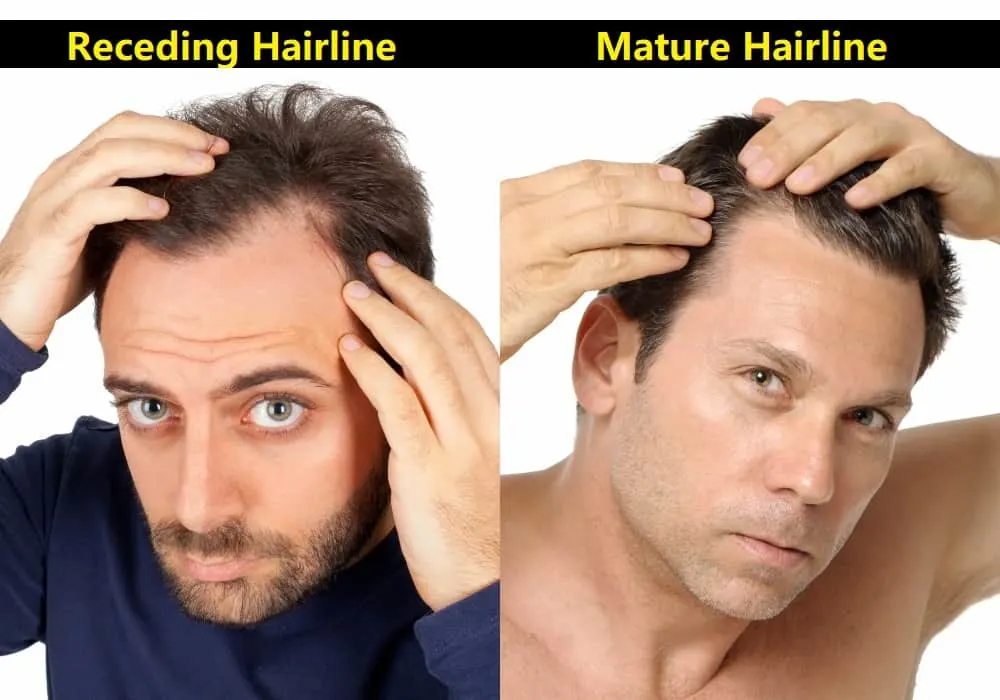 Receding-Hairline-vs.-Mature-Hairline.jpg.webp