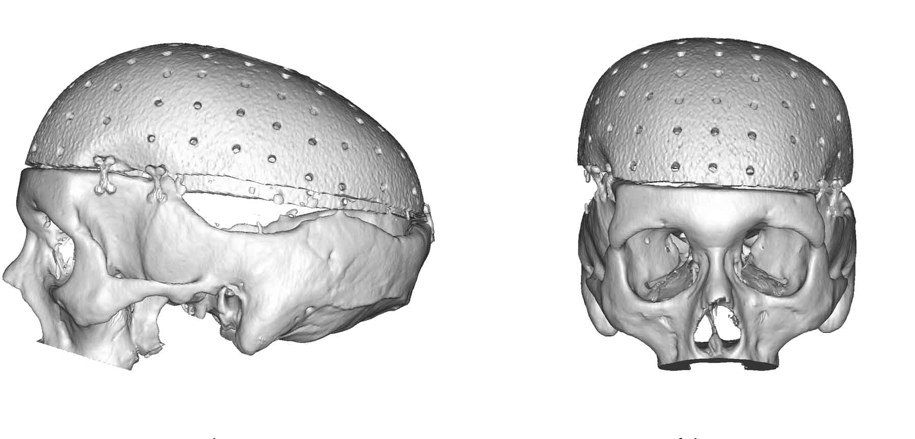Current-Total-Skull-Implant.jpg