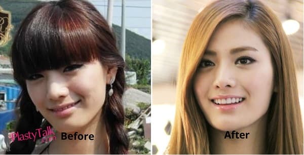Nana-Before-And-After-Plastic-Surgery-1.jpg