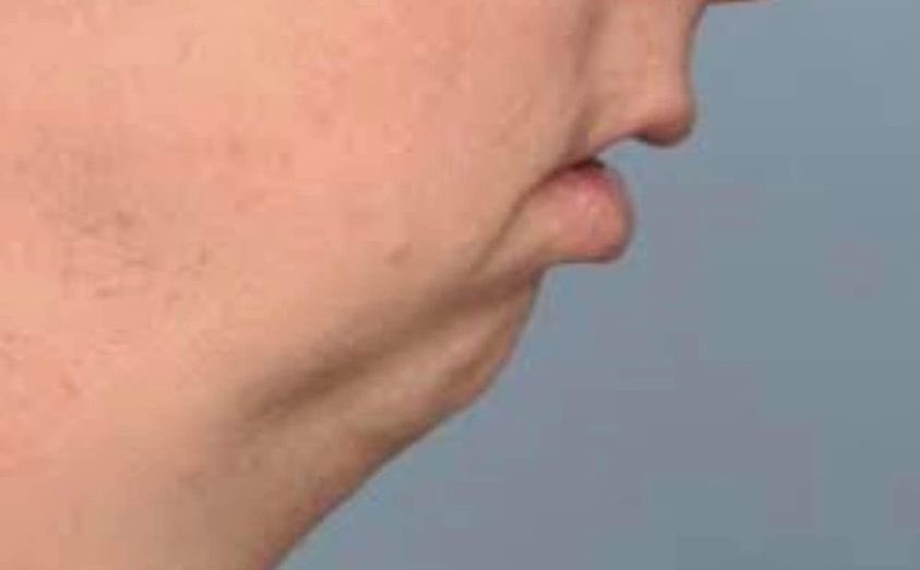 Colin on X: It is quite literally the no chin meme wtf  https://t.co/wMAjA7uS03 / X