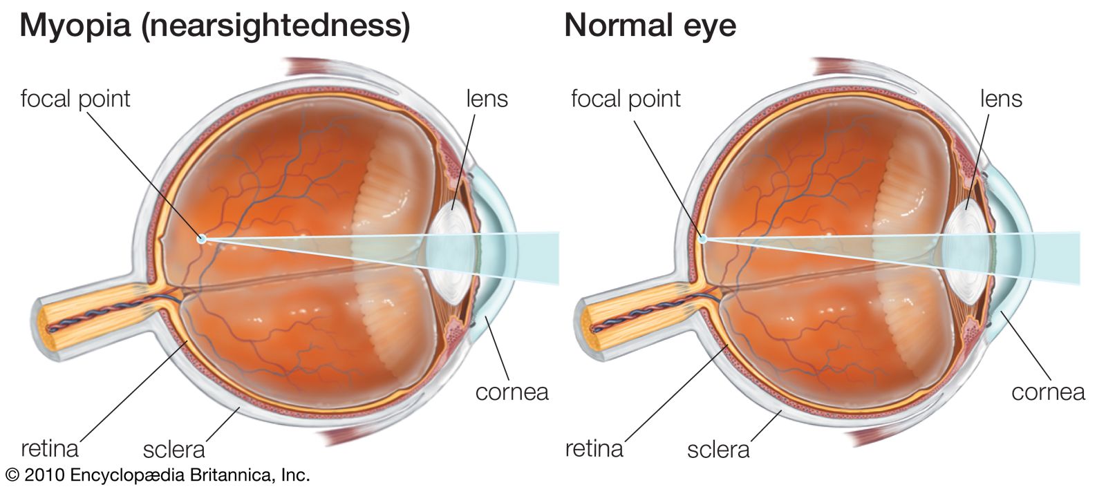 nearsightedness-glasses-Myopia-lenses-focus-eye-objects.jpg