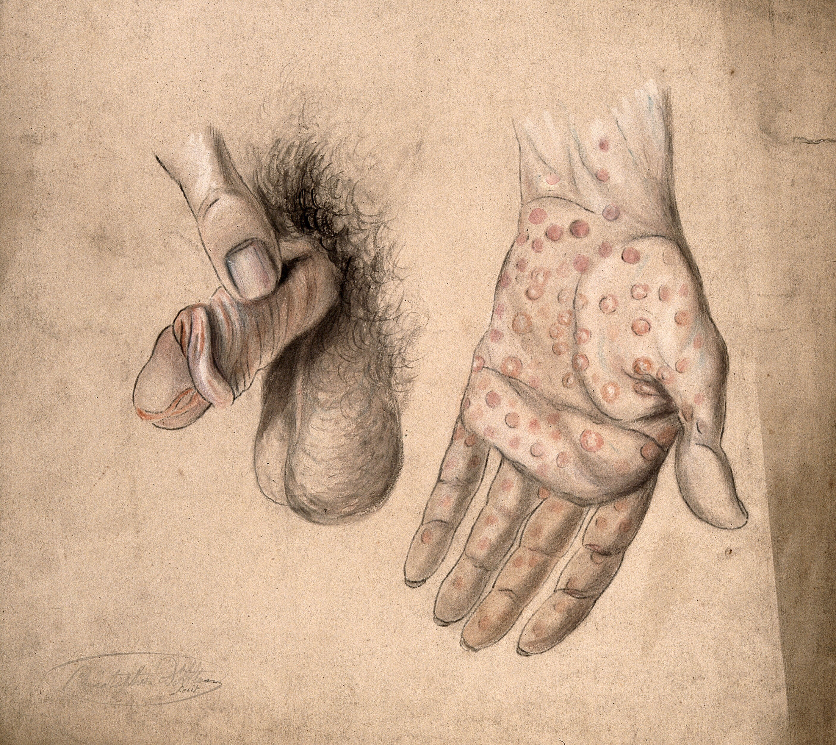 Diseased areas of tissue on the penis and the palm of the hand of a man:  two figures. Watercolour by C. D'Alton, 1857. | Wellcome Collection