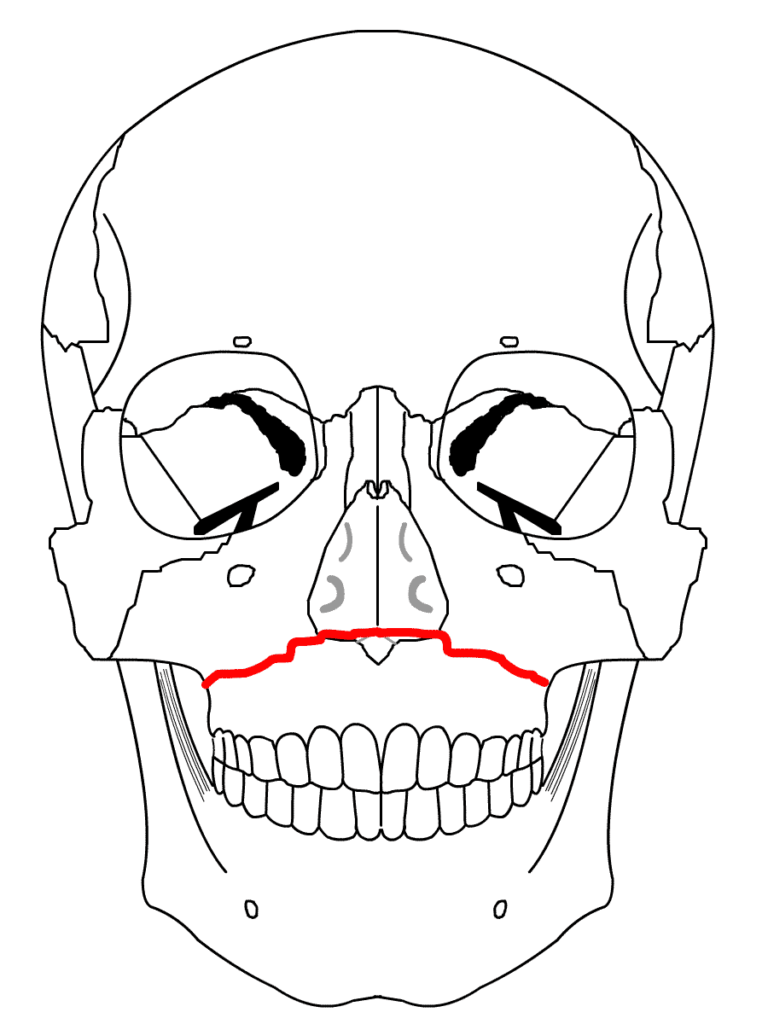 LeFort-1-768x1024.png