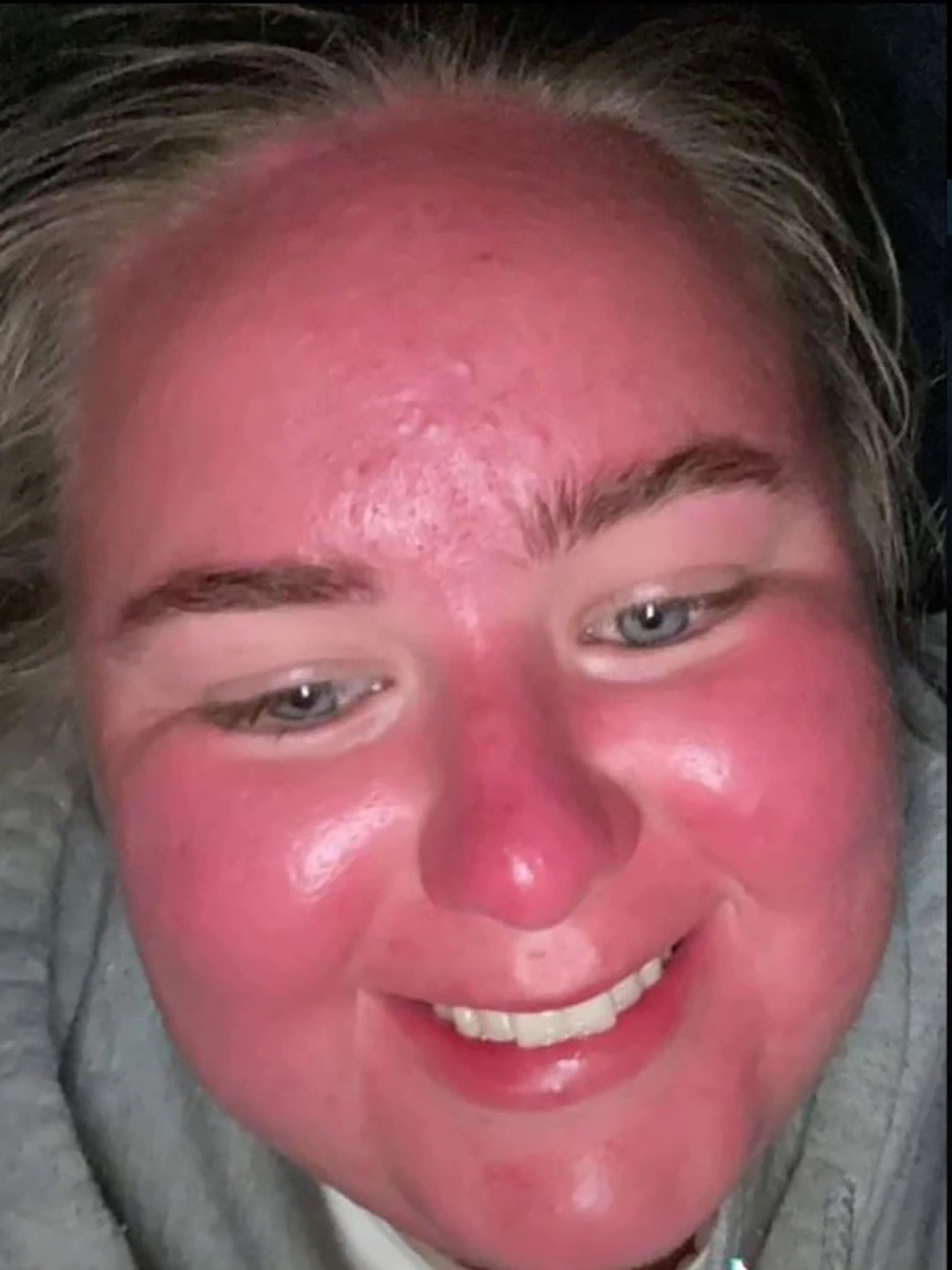 sunburned-woman-face-double-size-01.jpg