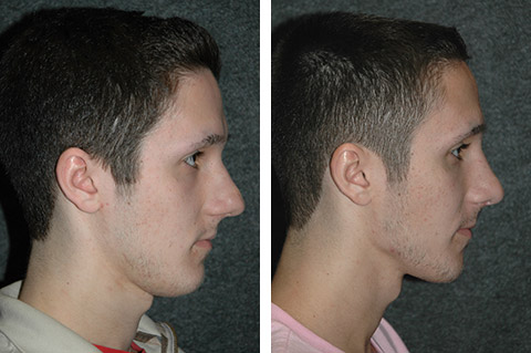 male-nose-job-profile-view.jpg