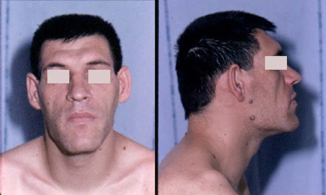 acromegaly_facial_features..jpg