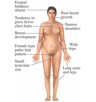 Klinefelter Syndrome | ucdreprosurvey