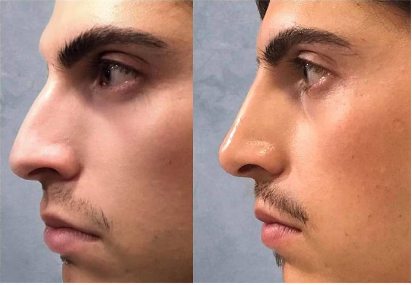 Nonsurgical-Rhino-e1533925276691.jpg