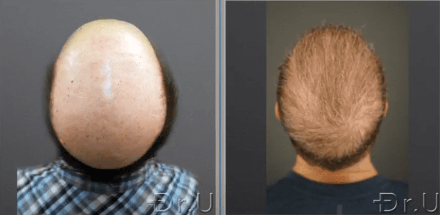 Before-after-crown.png