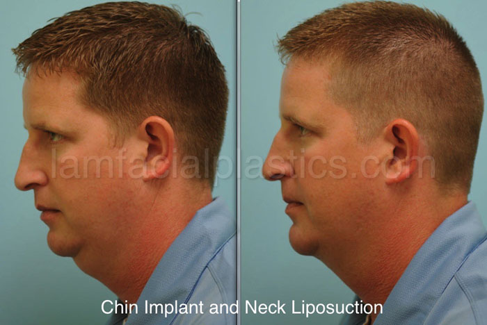 neck-liposuction-bxa-5.jpg