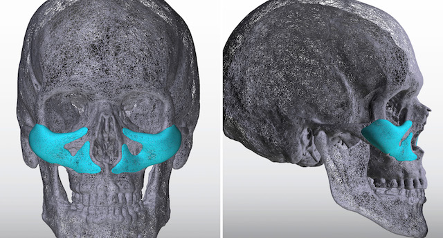 Custom-Midface-Implant-3D-views-Dr-Barry-Eppley-Indianapolis-1.jpg