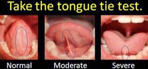 Tongue tie