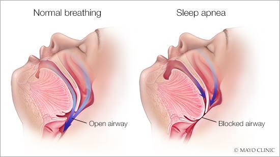 sleep-apnea-16x9-1.jpg