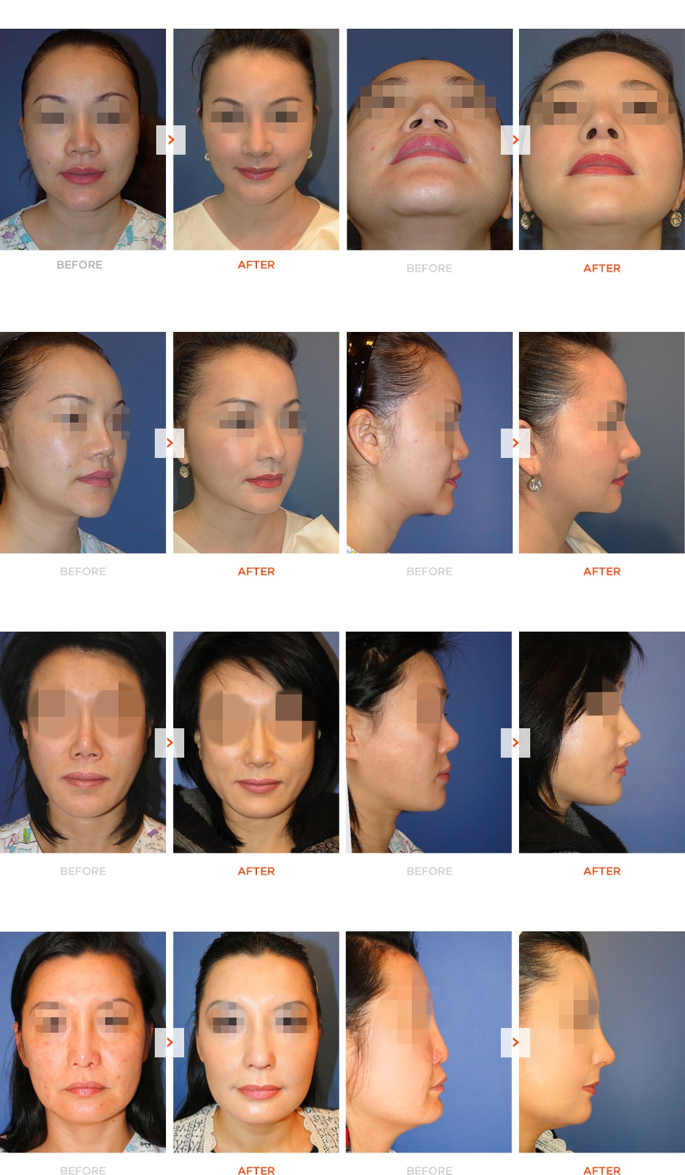 mid-face-augmentation-gallery.jpg