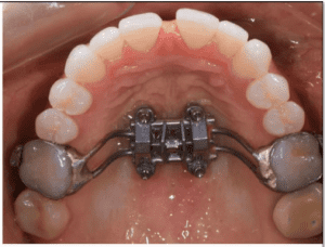 mse expander appliance