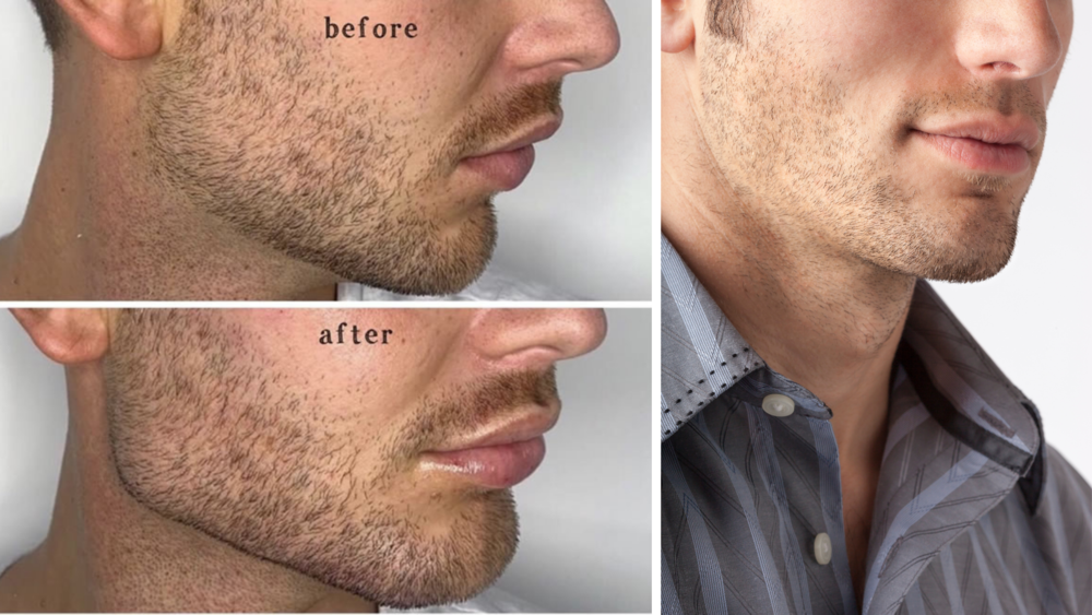 Mens jawline fillers