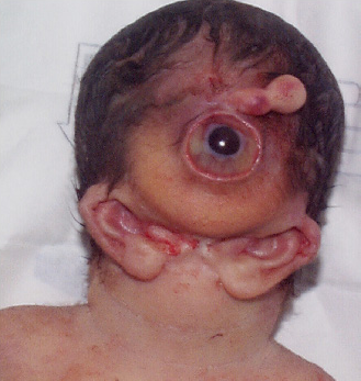Otocephaly_and_cyclopia.png