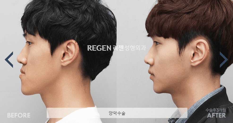 two-jaw-double-korea-2.png
