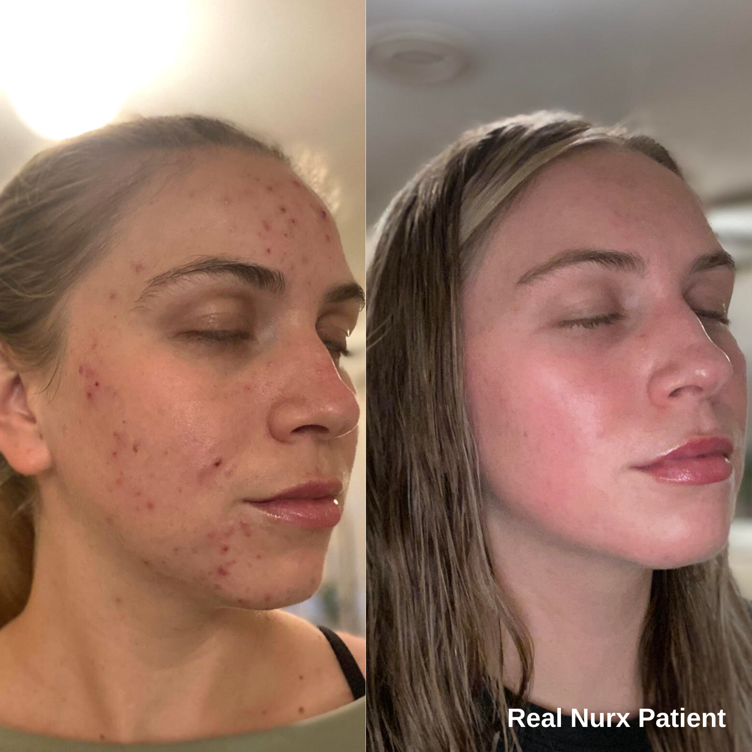 Dermatology-PDP-Photos-Shannon-Sturman-Before-After.png