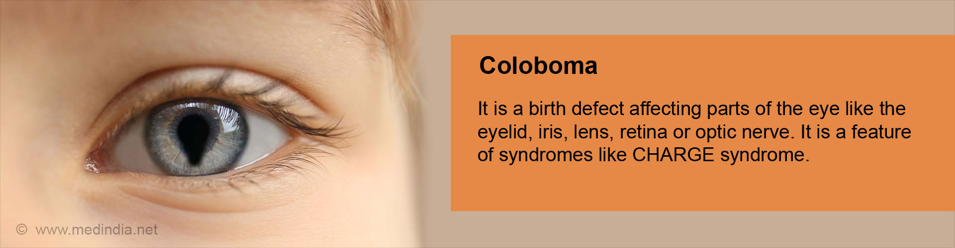 Image result for coloboma