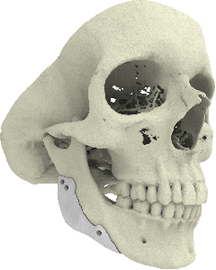 3D printed CT-Bone implant for mandible augmentation