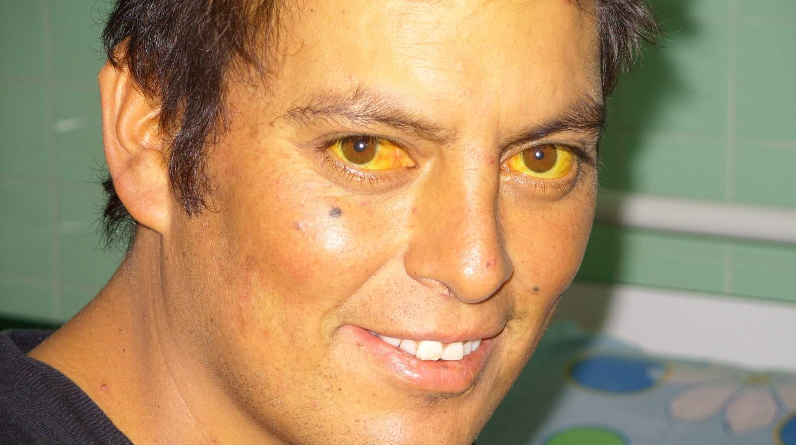 Bilirubin Metabolism and Jaundice - almostadoctor