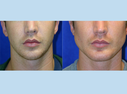 customimplants36.jpg